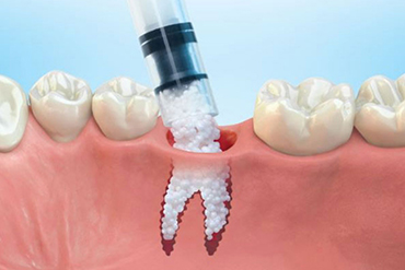 Bone Graft Placement